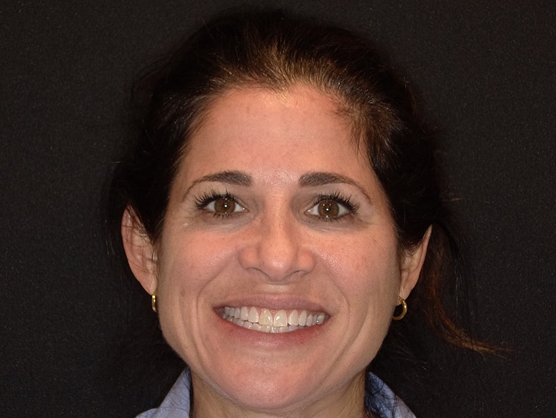 Smiling female patient with blonde hair after dental procedure at Vaccaro Aesthetic and Family Dentistry, Cosmetic Dentistry in Green Village, NJ