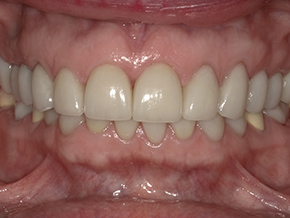 Post-treatment balanced smile photographed at Vaccaro Aesthetic and Family Dentistry in Green Village, NJ.