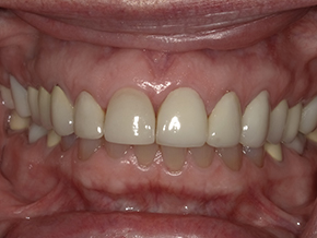 Posterior arch alignment results photographed at Vaccaro Aesthetic and Family Dentistry in Green Village, NJ.