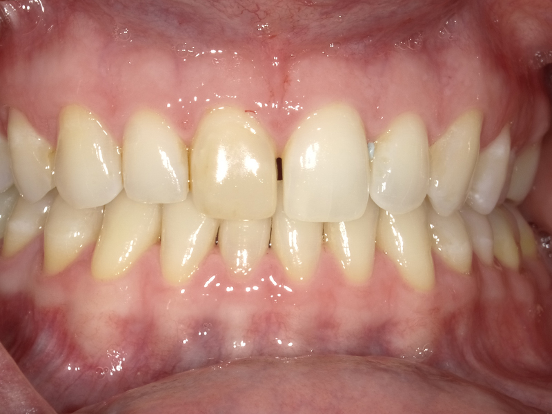 Minimal overbite with straightened front row photographed at Vaccaro Aesthetic and Family Dentistry in Green Village, NJ.