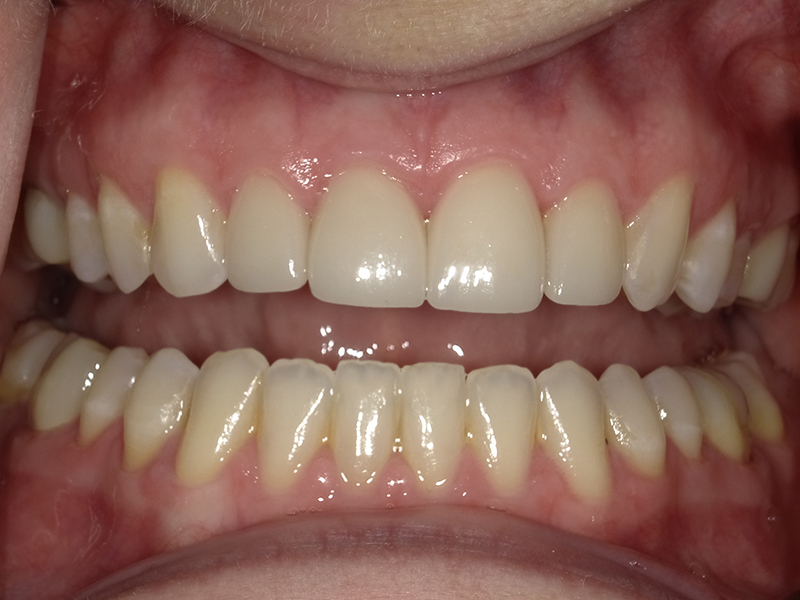 Corrected bite with straight upper row photographed at Vaccaro Aesthetic and Family Dentistry in Green Village, NJ.