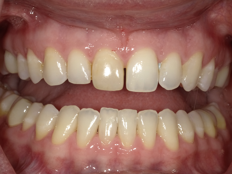 Clean and aligned smile photographed at Vaccaro Aesthetic and Family Dentistry in Green Village, NJ.