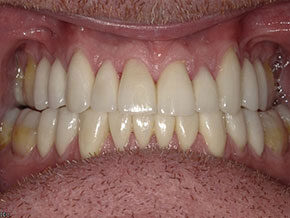 Lower front teeth alignment post-braces as seen at Vaccaro Aesthetic and Family Dentistry in Green Village, NJ.