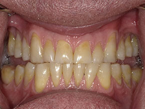 Yellowed teeth with tartar buildup photographed at Vaccaro Aesthetic and Family Dentistry in Green Village, NJ.