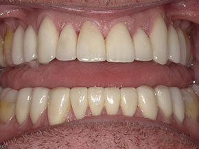 Natural smile with aligned teeth as seen at Vaccaro Aesthetic and Family Dentistry in Green Village, NJ.
