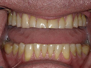 Stained upper and lower teeth before cleaning photographed at Vaccaro Aesthetic and Family Dentistry in Green Village, NJ.