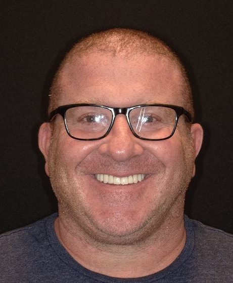 Clean upper arch post-polish as seen at Vaccaro Aesthetic and Family Dentistry in Green Village, NJ.