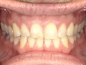 Natural-looking smile after composite veneers and subtle reshaping to improve uniformity.