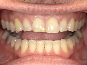 Smile with visible staining and slight misalignment before whitening and orthodontic treatment.