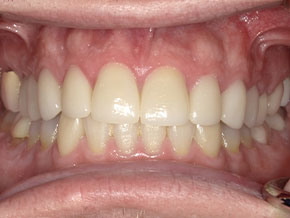 Gum contouring and smile balance as seen at Vaccaro Aesthetic and Family Dentistry in Green Village, NJ.