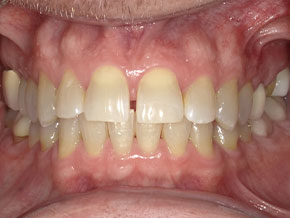 Teeth straightened with clear aligners as seen at Vaccaro Aesthetic and Family Dentistry in Green Village, NJ.