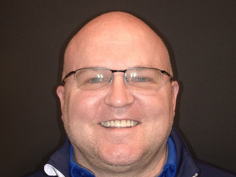 Tooth-colored filling on molars as seen at Vaccaro Aesthetic and Family Dentistry in Green Village, NJ.