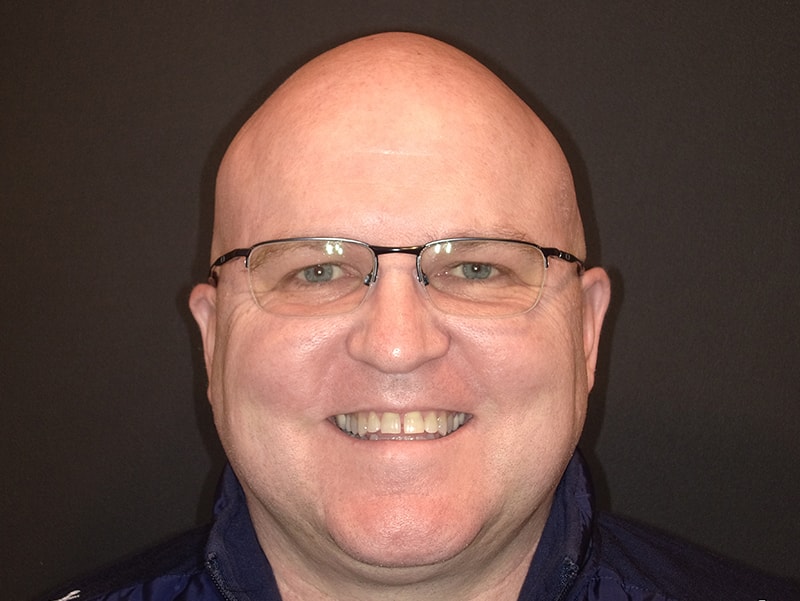 Tightened tooth gaps after bonding as seen at Vaccaro Aesthetic and Family Dentistry in Green Village, NJ.