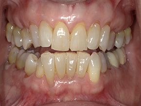 Close-up of patient teeth before or after general dentistry at Vaccaro Aesthetic and Family Dentistry in Green Village, NJ.