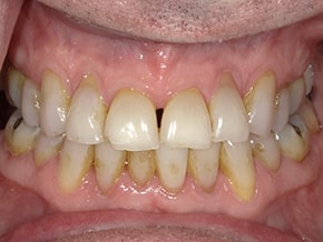 Close-up of upper and lower teeth with yellow staining and mild crowding at Vaccaro Aesthetic and Family Dentistry, General Dentistry in Green Village, NJ