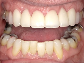Close-up of upper and lower teeth with significant tartar and uneven bite at Vaccaro Aesthetic and Family Dentistry, Dental Clinic in Green Village, NJ