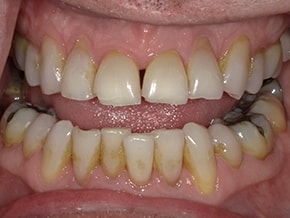 Close-up of upper and lower teeth showing yellow discoloration and mild dental wear at Vaccaro Aesthetic and Family Dentistry, Dental Office in Green Village, NJ