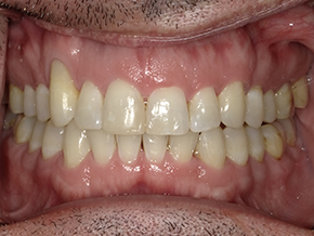 Close-up of upper and lower teeth with mild alignment issues and yellow discoloration at Vaccaro Aesthetic and Family Dentistry, Dental Clinic in Green Village, NJ