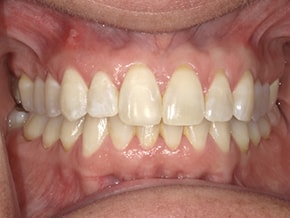 Intraoral view of upper and lower teeth with mild yellowing and even alignment at Vaccaro Aesthetic and Family Dentistry, Orthodontics in Green Village, NJ