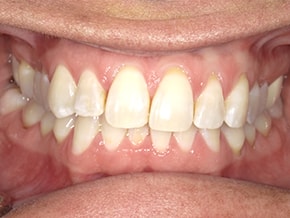 Close-up of upper and lower front teeth showing straight alignment and healthy enamel at Vaccaro Aesthetic and Family Dentistry, General Dentistry in Green Village, NJ